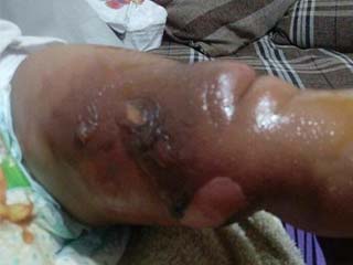 حرق «بشرى» بسبب الإهمال بالحضانة