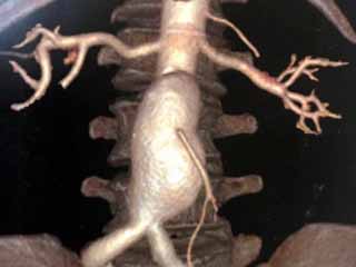 نجاح أول عملية تمدد شريان الأورطى بدون جراحة